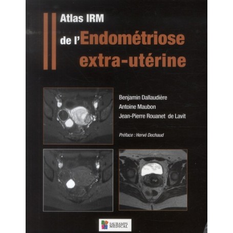 ATLAS IRM DE L'ENDOMETRIOSE EXTRA-UTERINE