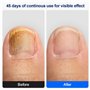 Mycose Ongles Pied Appareil Traitement avec Minuterie et Lumière rouge & bleue & laser froid pour Traitement Champignons Ongles 