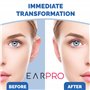 Correcteur d'oreille pour Protubérance de l'oreille - Correction de l'esthétique de l'oreille - Correcteurs esthétiques - correc