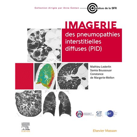 Imagerie des pneumopathies interstitielles diffuses (PID) 74,36 €