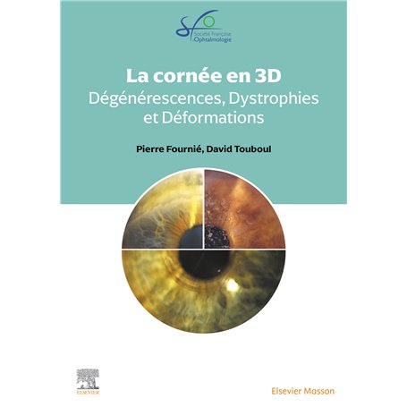 La Cornée en 3D : dégénérescences