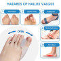Impoditiongs 6 Pièces Correcteur Hallux Valgus,Étirement Ecarteur d'orteil,Séparateur d'Orteils en Silicone,Correcteur d'Orteils