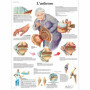 Poster Laminé sur l'Arthrose - Anatomie et Pathologie pour Enseignement
