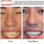 Prothèse Dentaire Complète en Silicone de Qualité Supérieure – Dentier Amovible Immédiat pour Homme et Femme – Fausses Dents Nat
